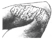 NEET Biology Human Health and Diseases MCQs Set A-Q87